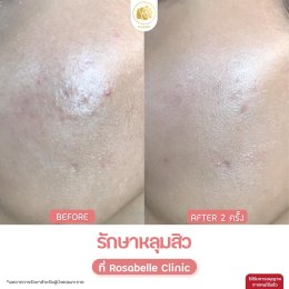 รวมรูปรีวิวโปรแกรมรักษาหลุมสิว