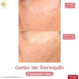 รวมรูปรีวิวโปรแกรมรักษาหลุมสิว
