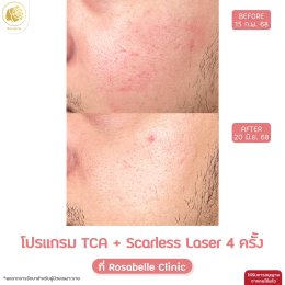 รวมรูปรีวิวโปรแกรมรักษาหลุมสิว