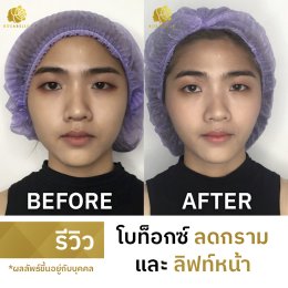 รีวิวโบท็อกซ์