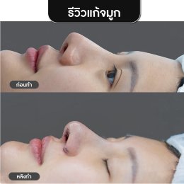 รีวิวศัลยกรรมจมูก