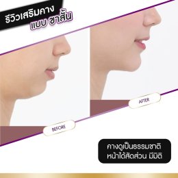 รีวิวศัลยกรรมคาง