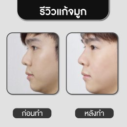 รีวิวศัลยกรรมจมูก