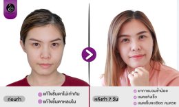 รีวิวศัลยกรรมตา