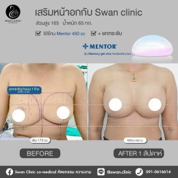 รีวิวศัลยกรรมหน้าอก