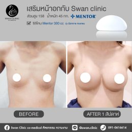 รีวิวศัลยกรรมหน้าอก