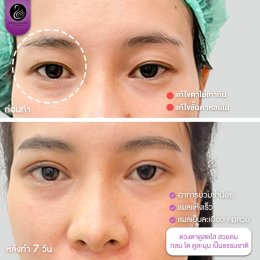 รีวิวศัลยกรรมตา