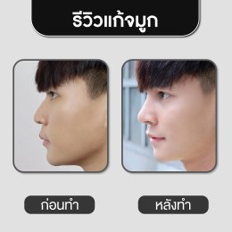 รีวิวศัลยกรรมจมูก