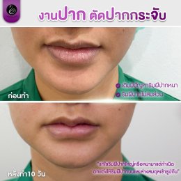รีวิวศัลยกรรมปาก