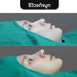 รีวิวศัลยกรรมจมูก