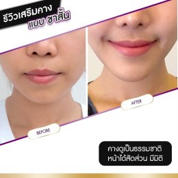 รีวิวศัลยกรรมคาง