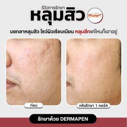 รีวิวรักษาหลุมสิว