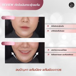 รีวิวตัดไขมันกระพุ้งแก้ม