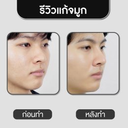 รีวิวศัลยกรรมจมูก