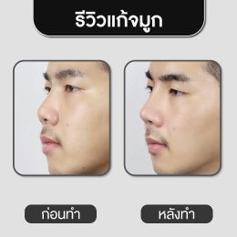 รีวิวศัลยกรรมจมูก