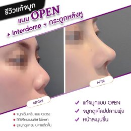 รีวิวศัลยกรรมจมูก
