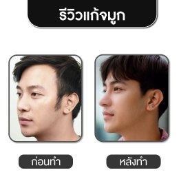 รีวิวศัลยกรรมจมูก