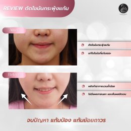 รีวิวตัดไขมันกระพุ้งแก้ม