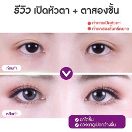 รีวิวศัลยกรรมตา