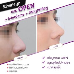 รีวิวศัลยกรรมจมูก