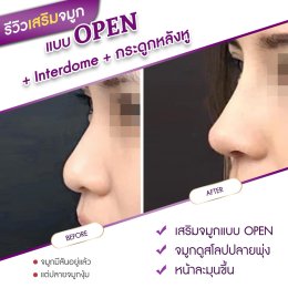 รีวิวศัลยกรรมจมูก