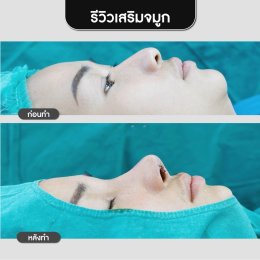 รีวิวศัลยกรรมจมูก