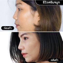 รีวิวศัลยกรรมจมูก