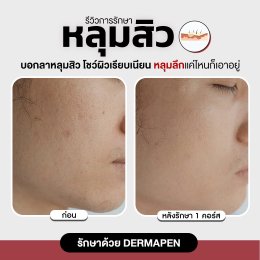รีวิวรักษาหลุมสิว