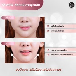 รีวิวตัดไขมันกระพุ้งแก้ม
