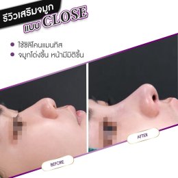 รีวิวศัลยกรรมจมูก