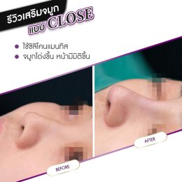 รีวิวศัลยกรรมจมูก