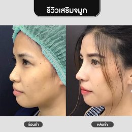 รีวิวศัลยกรรมจมูก