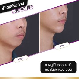 รีวิวศัลยกรรมคาง