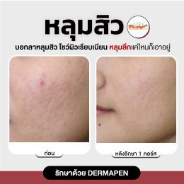 รีวิวรักษาหลุมสิว