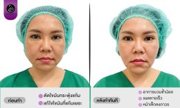 รีวิวตัดไขมันกระพุ้งแก้ม