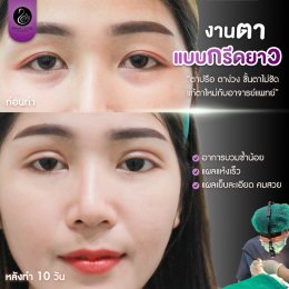 รีวิวศัลยกรรมตา