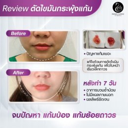 รีวิวตัดไขมันกระพุ้งแก้ม