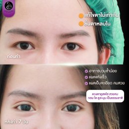 รีวิวศัลยกรรมตา