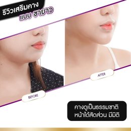 รีวิวศัลยกรรมคาง