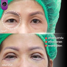 รีวิวศัลยกรรมตา