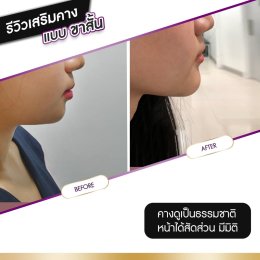 รีวิวศัลยกรรมคาง