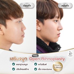รีวิวศัลยกรรมจมูก