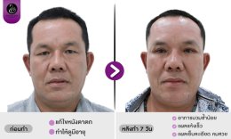 รีวิวศัลยกรรมตา
