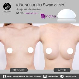 รีวิวศัลยกรรมหน้าอก