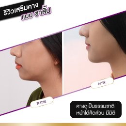 รีวิวศัลยกรรมคาง