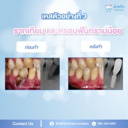 รากเทียม