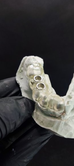 Straumann Implant