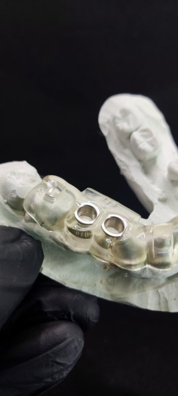 Straumann Implant