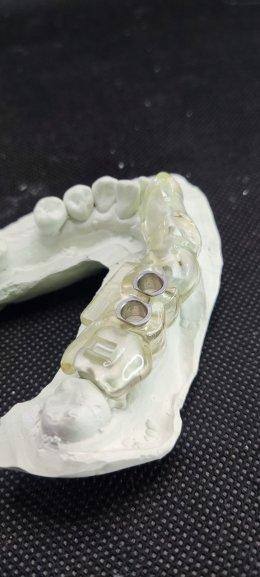 Straumann Implant