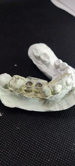 Straumann Implant